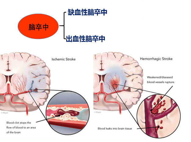 1-脑中风主要有缺血性中风和出血性脑卒中.jpg 1-脑中风主要有缺血性中风和出血性脑卒中.jpg